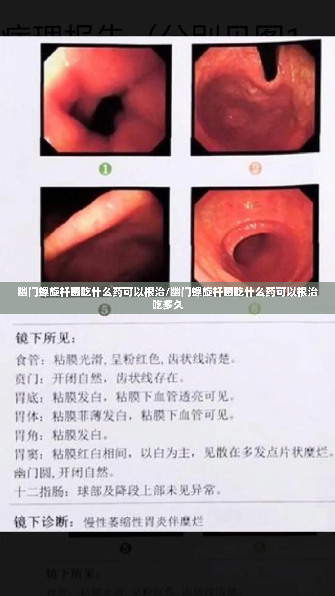 幽门螺旋杆菌吃什么药可以根治/幽门螺旋杆菌吃什么药可以根治吃多久