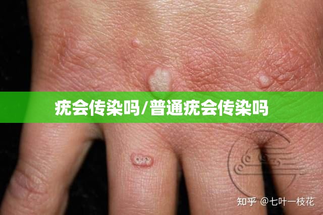 疣会传染吗/普通疣会传染吗