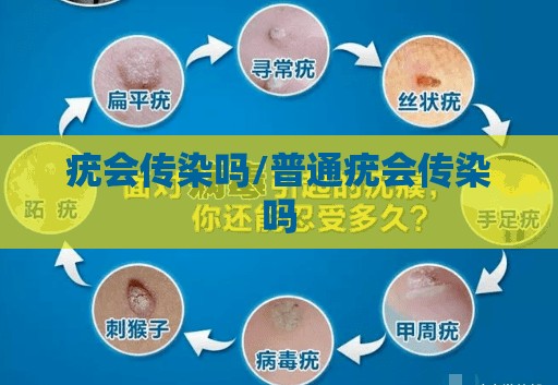 疣会传染吗/普通疣会传染吗