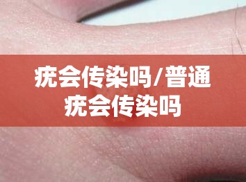 疣会传染吗/普通疣会传染吗