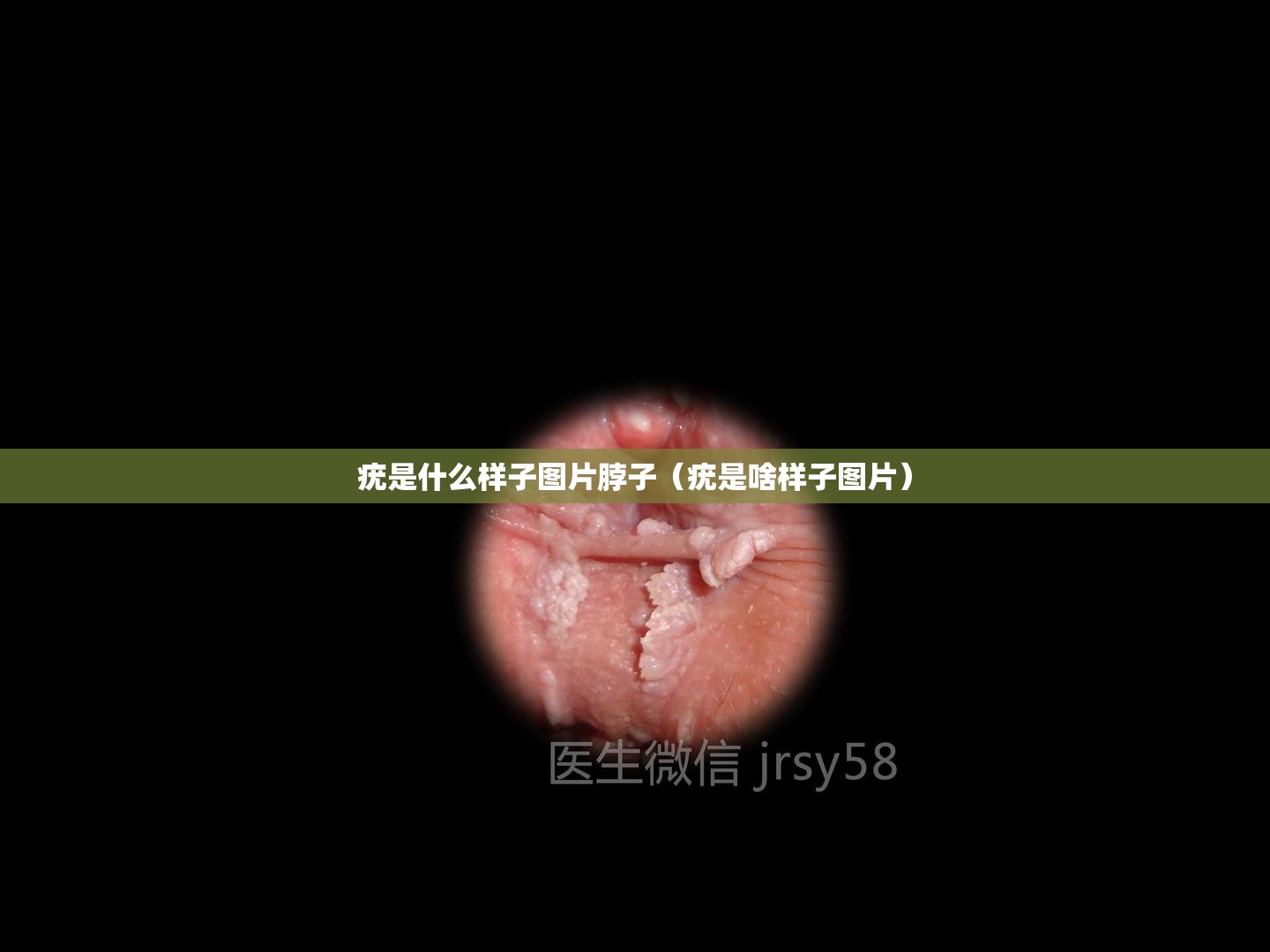 疣是什么样子图片脖子（疣是啥样子图片）