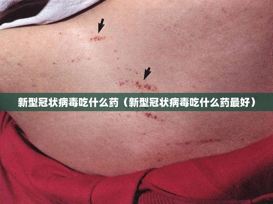 新型冠状病毒吃什么药（新型冠状病毒吃什么药最好）