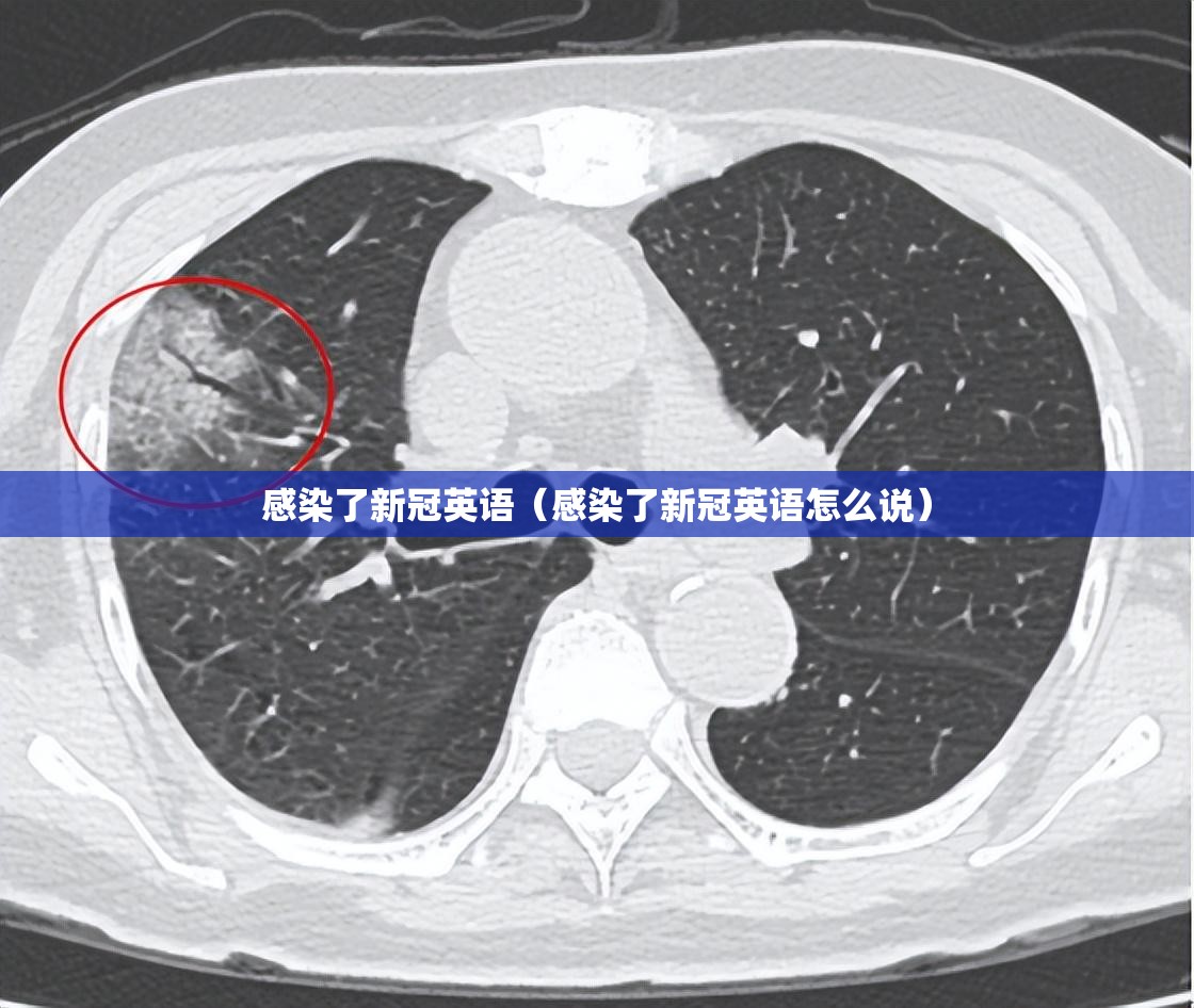 感染了新冠英语（感染了新冠英语怎么说）