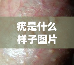 疣是什么样子图片hpv/疣是什么样子图片脖子