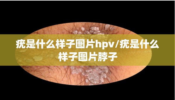 疣是什么样子图片hpv/疣是什么样子图片脖子