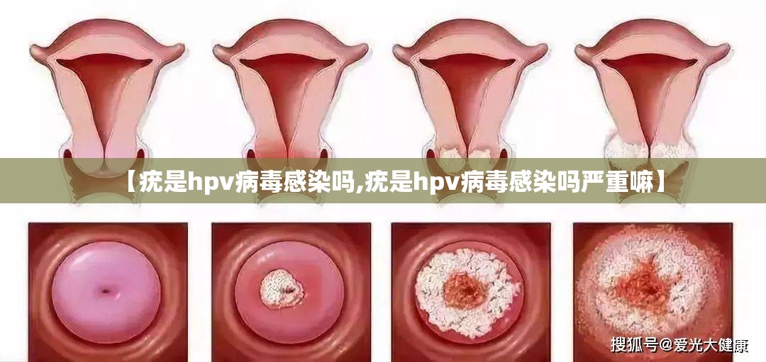 【疣是hpv病毒感染吗,疣是hpv病毒感染吗严重嘛】