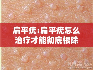 扁平疣:扁平疣怎么治疗才能彻底根除