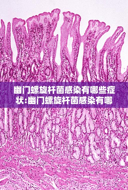 幽门螺旋杆菌感染有哪些症状:幽门螺旋杆菌感染有哪些症状吃什么药