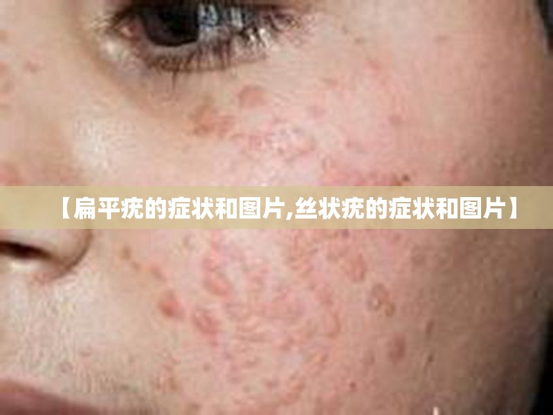 【扁平疣的症状和图片,丝状疣的症状和图片】