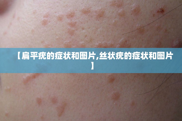 【扁平疣的症状和图片,丝状疣的症状和图片】