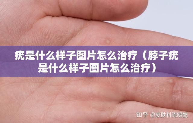 疣是什么样子图片怎么治疗（脖子疣是什么样子图片怎么治疗）