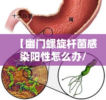 【幽门螺旋杆菌感染阳性怎么办/幽门螺旋杆菌感染阳性怎么办吃什么药】