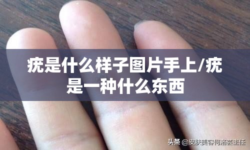 疣是什么样子图片手上/疣是一种什么东西