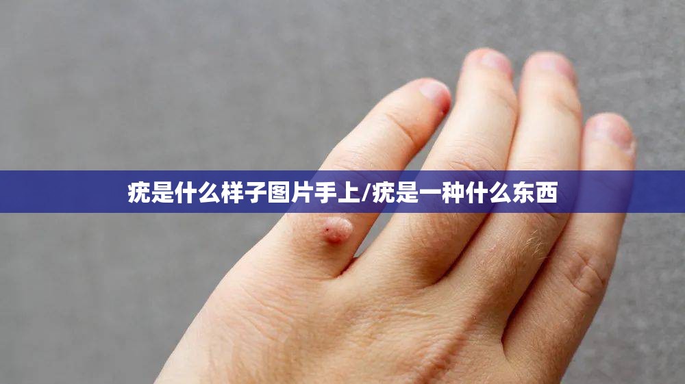 疣是什么样子图片手上/疣是一种什么东西