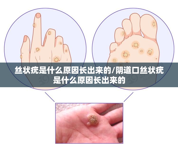丝状疣是什么原因长出来的/阴道口丝状疣是什么原因长出来的