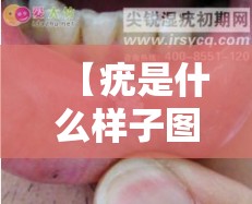 【疣是什么样子图片初期/疣是一种什么东西】