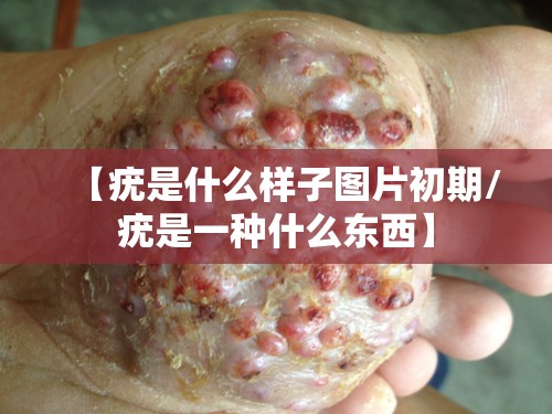 【疣是什么样子图片初期/疣是一种什么东西】