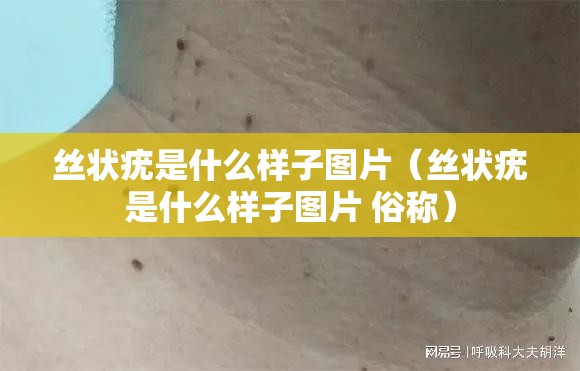 丝状疣是什么样子图片（丝状疣是什么样子图片 俗称）